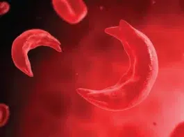Una mujer de Silver Spring se convierte en la primera paciente adulta con anemia falciforme en Maryland en recibir terapia génica aprobada por la FDA anemia falciforme