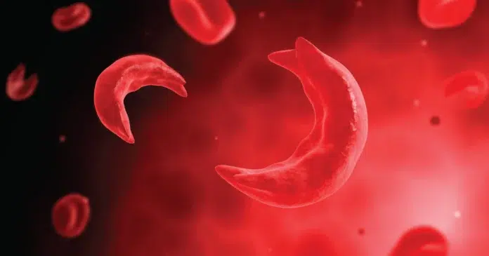 anemia falciforme